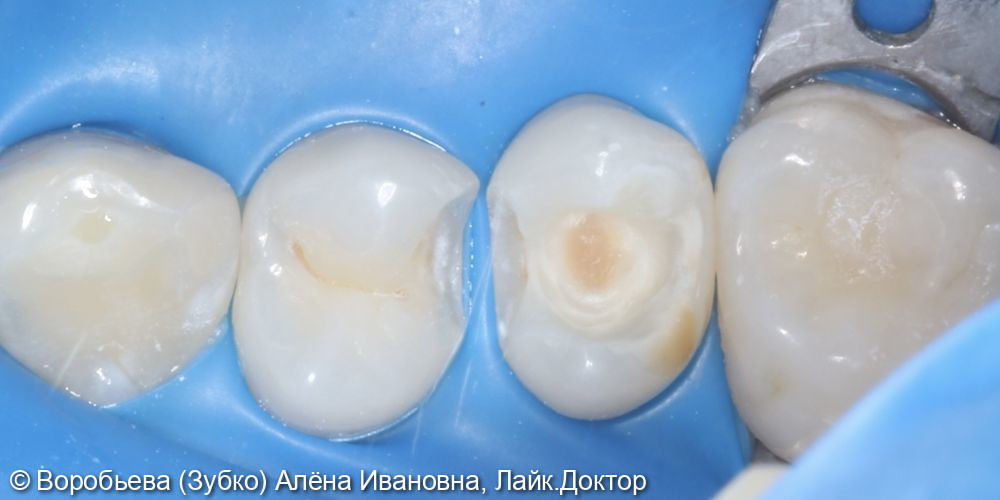 Лечение кариеса 15 и 14 зуба - фото №2