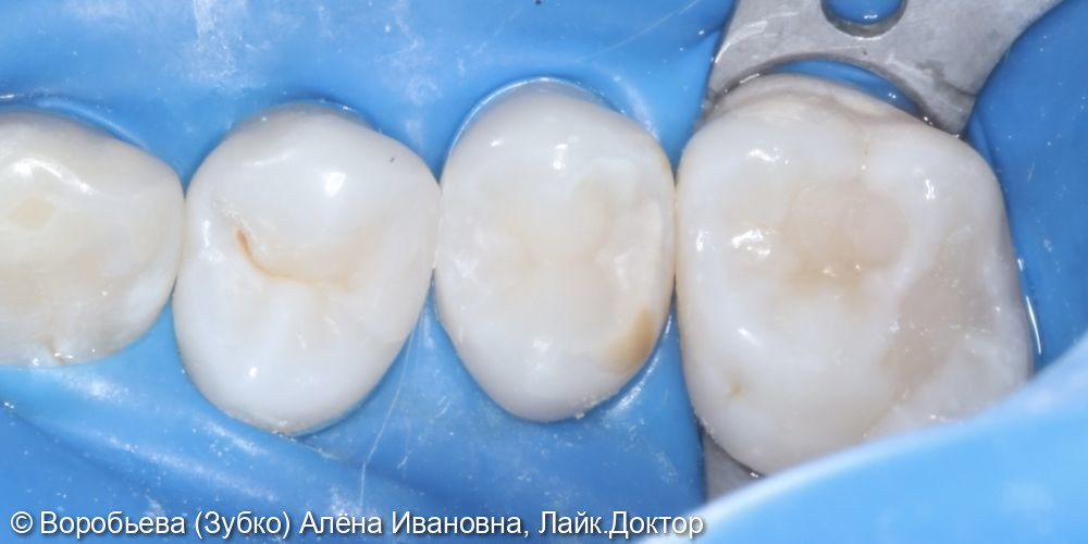 Лечение кариеса 15 и 14 зуба - фото №3