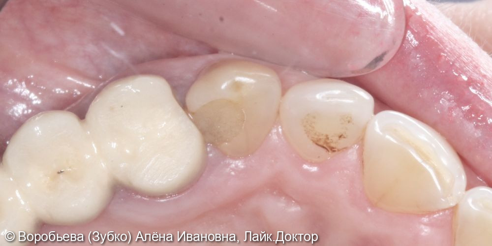 Лечение периодонтита 2.3 зуба и удаление сломанного инструмента - фото №1