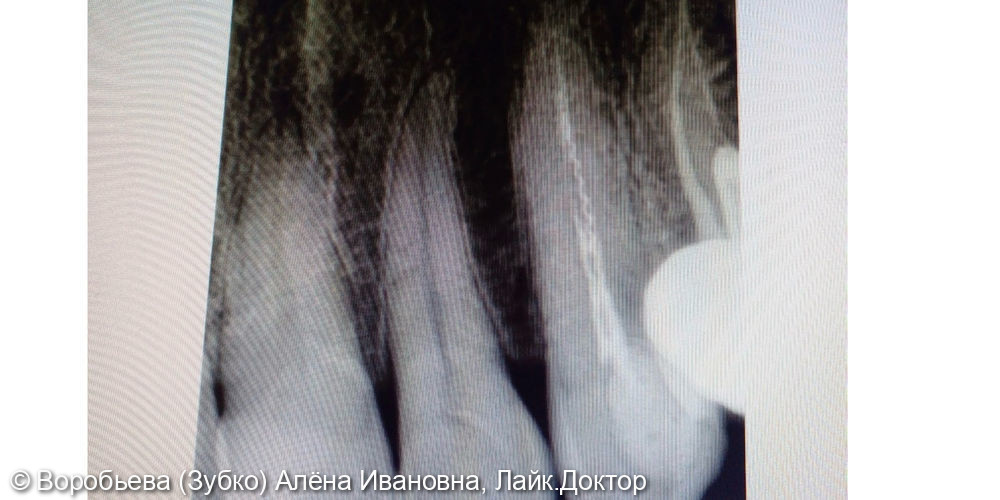 Лечение периодонтита 2.3 зуба и удаление сломанного инструмента - фото №2