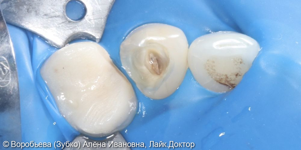 Лечение периодонтита 2.3 зуба и удаление сломанного инструмента - фото №3