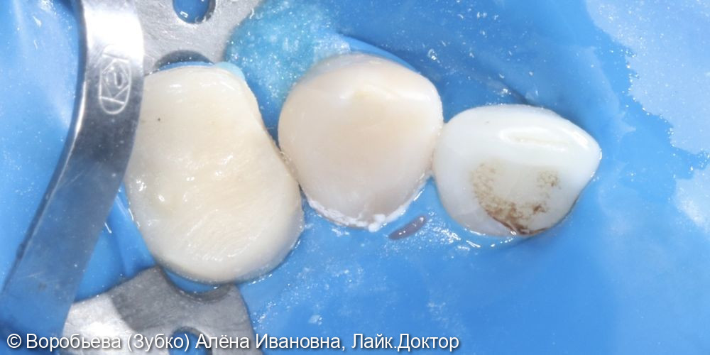 Лечение периодонтита 2.3 зуба и удаление сломанного инструмента - фото №5