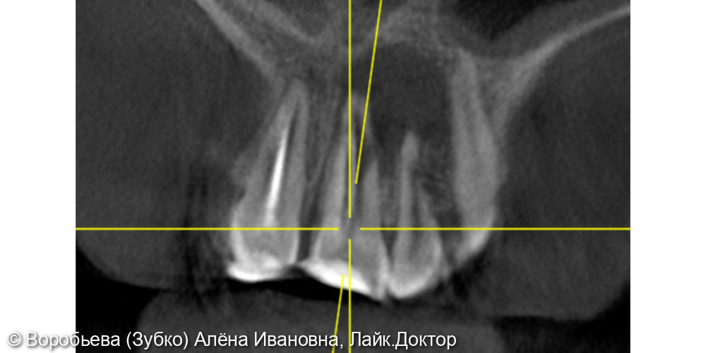 Лечение периодонтита 21 и 11 зуба - фото №1
