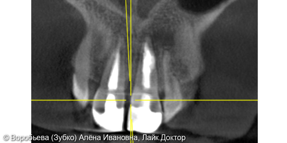 Лечение периодонтита 21 и 11 зуба - фото №4