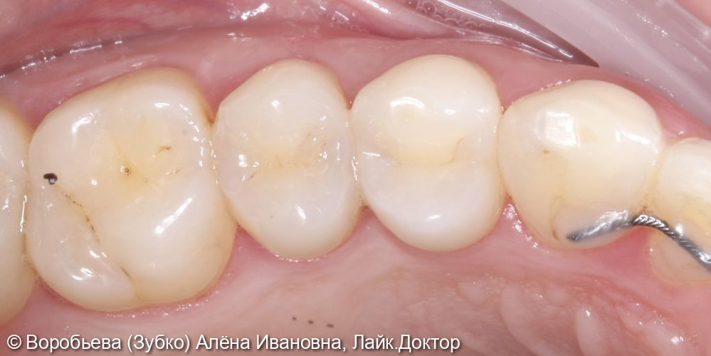 Лечение кариеса 24 и 25 зуба - фото №1