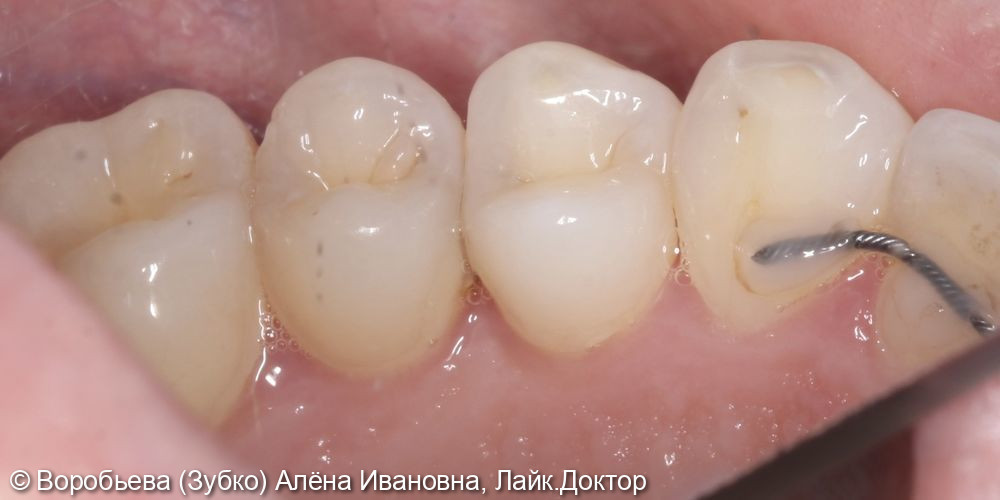 Лечение кариеса 24 и 25 зуба - фото №2