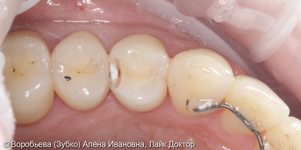 Лечение кариеса 24 и 25 зуба - фото №3