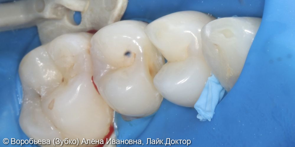 Лечение кариеса 24 и 25 зуба - фото №4