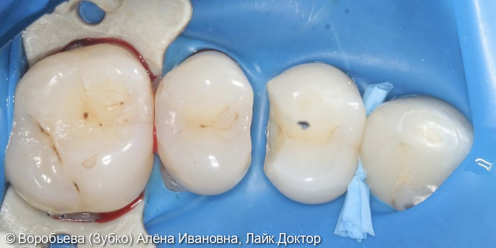 Лечение кариеса 24 и 25 зуба - фото №5