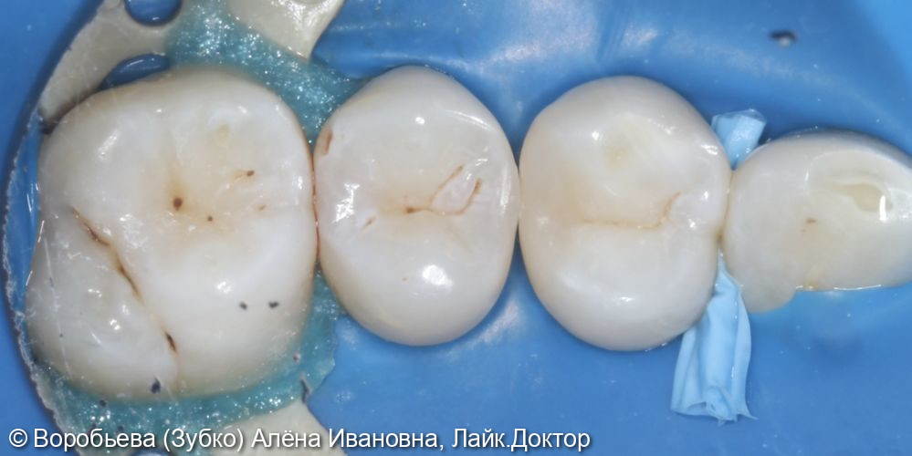 Лечение кариеса 24 и 25 зуба - фото №6