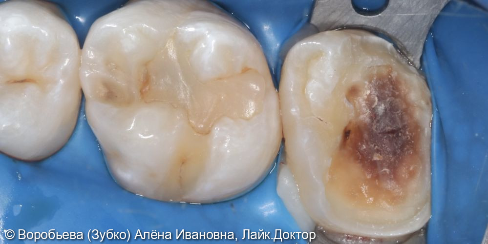 Лечение глубокого кариеса 16 зуба - фото №2