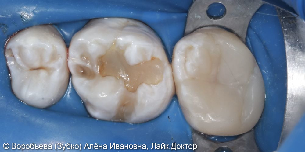 Лечение глубокого кариеса 16 зуба - фото №4