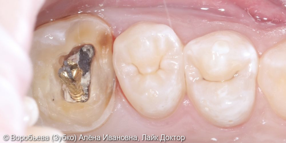 Лечение периодонтита и ортопедическое восстановление 26 зуба - фото №2