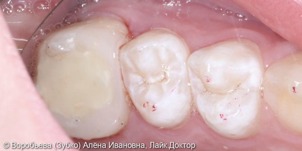 Лечение периодонтита и ортопедическое восстановление 26 зуба - фото №3