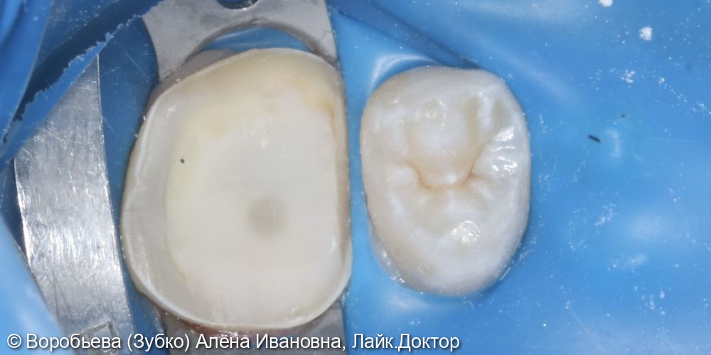 Лечение периодонтита и ортопедическое восстановление 26 зуба - фото №5