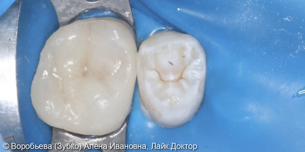 Лечение периодонтита и ортопедическое восстановление 26 зуба - фото №6