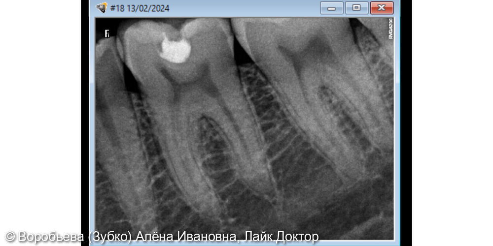 Лечение кариеса 36 и 37 зуба - фото №2