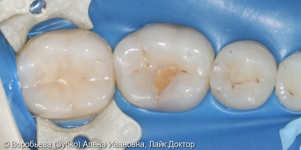 Лечение кариеса 36 и 37 зуба - фото №3