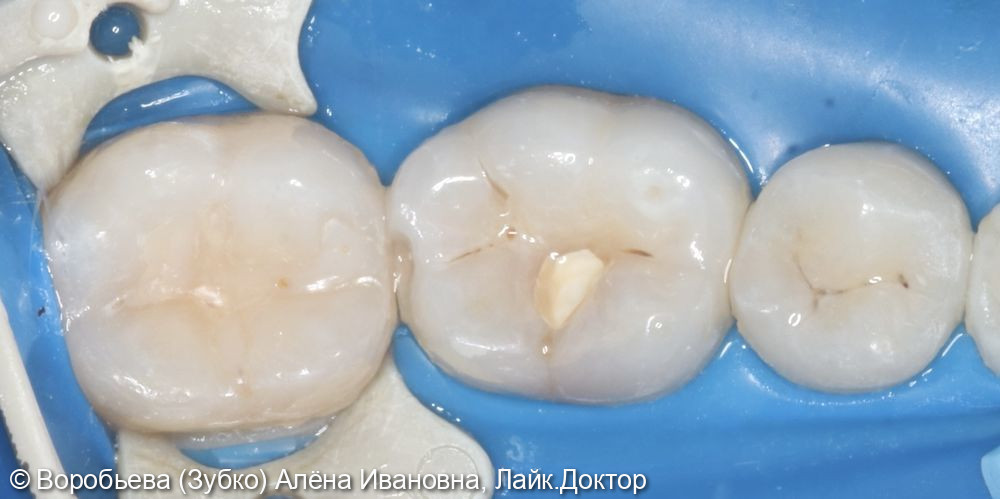 Лечение кариеса 36 и 37 зуба - фото №4