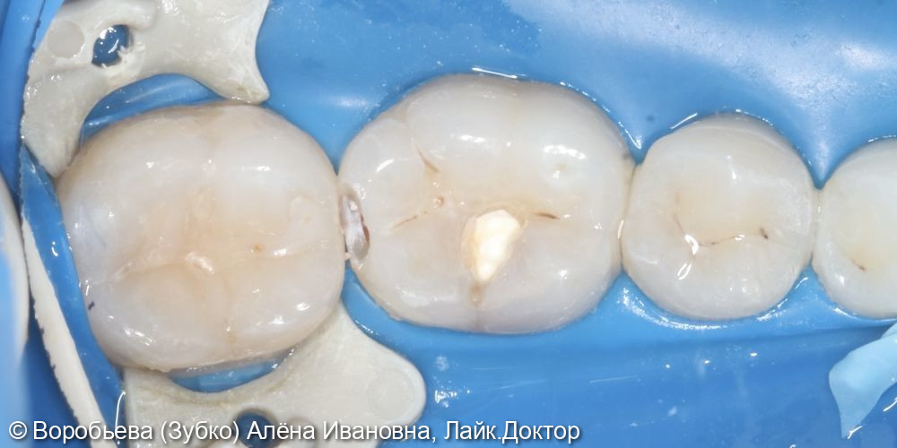 Лечение кариеса 36 и 37 зуба - фото №5