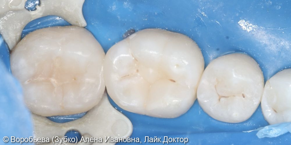 Лечение кариеса 36 и 37 зуба - фото №8