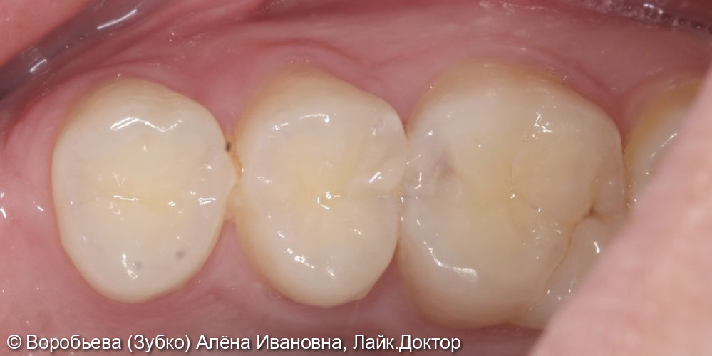 Лечение кариеса 15 и 16 зубов - фото №1