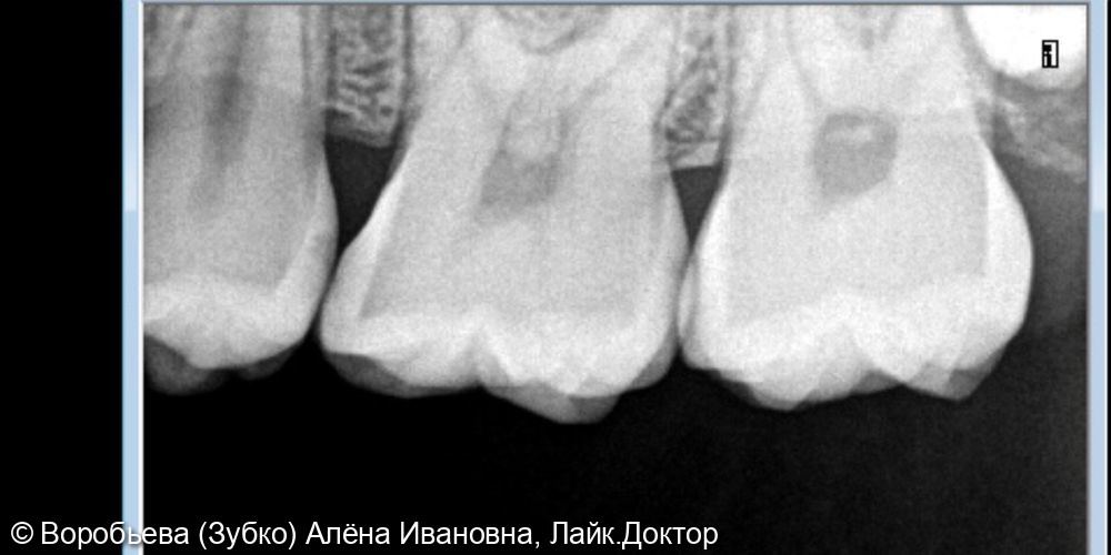 Лечение кариеса 15 и 16 зубов - фото №2