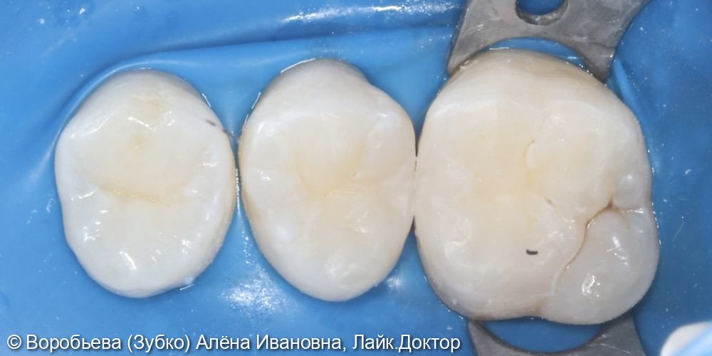 Лечение кариеса 15 и 16 зубов - фото №4
