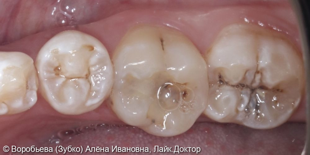 Лечение кариеса 46 и 47 зуба - фото №1