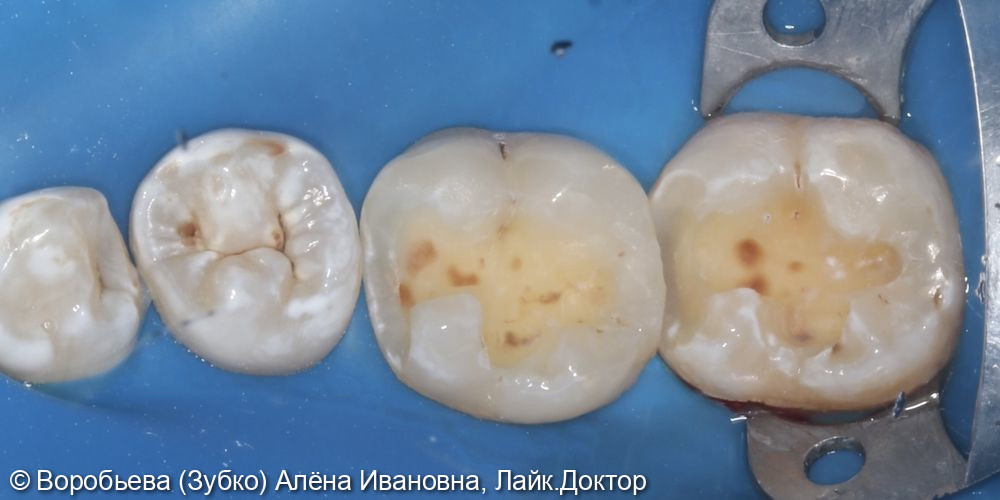 Лечение кариеса 46 и 47 зуба - фото №2