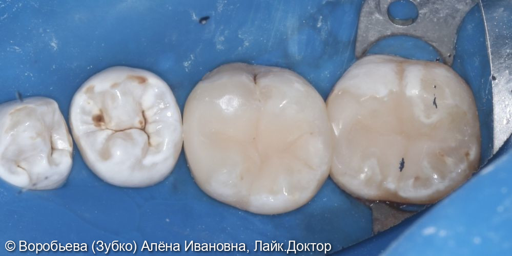 Лечение кариеса 46 и 47 зуба - фото №3