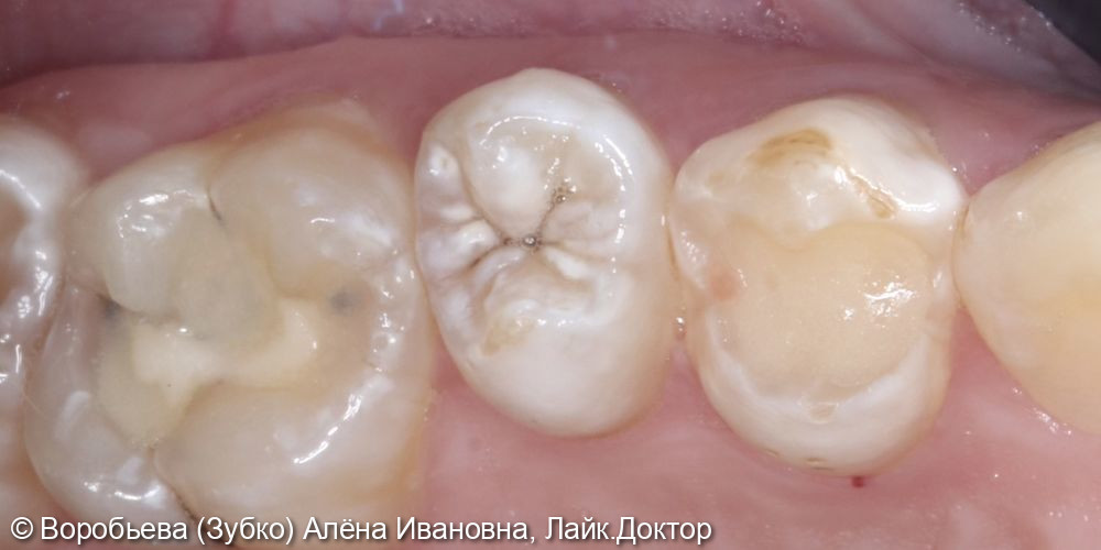 Лечение кариеса 24 зуба - фото №1