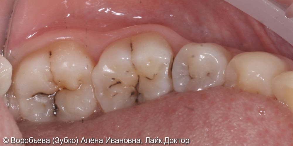 Лечение кариеса 37,36,35 зуба - фото №1