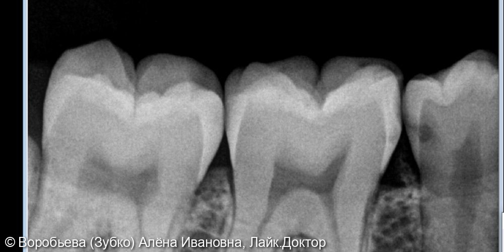 Лечение кариеса 37,36,35 зуба - фото №2