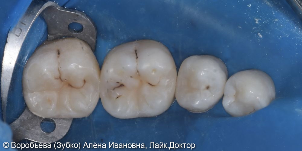 Лечение кариеса 37,36,35 зуба - фото №4
