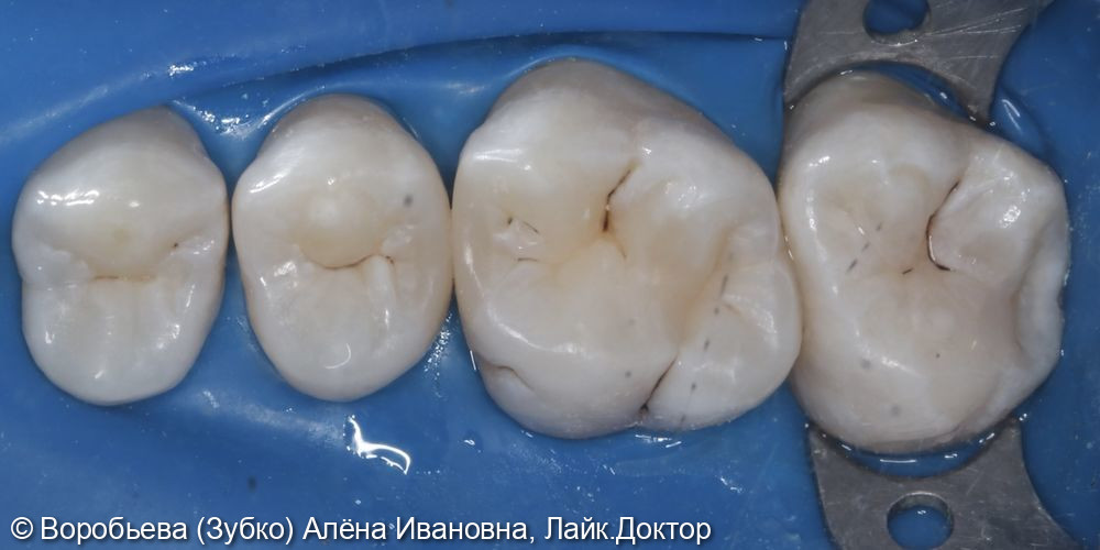 Лечение кариеса 17,16,15 зубов - фото №4