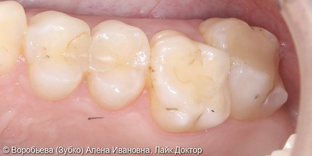 Лечение кариеса 17,16,15,14 зубов - фото №1