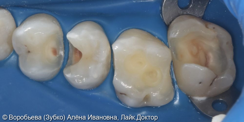 Лечение кариеса 17,16,15,14 зубов - фото №2