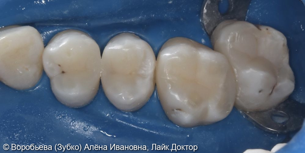 Лечение кариеса 17,16,15,14 зубов - фото №4