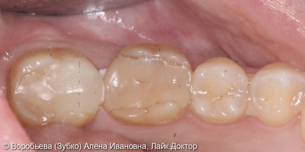 Лечение периодонтита 36 зуба и лечение кариеса 35 зуба - фото №1