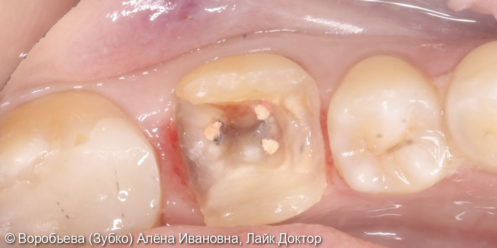 Лечение периодонтита 36 зуба и лечение кариеса 35 зуба - фото №2