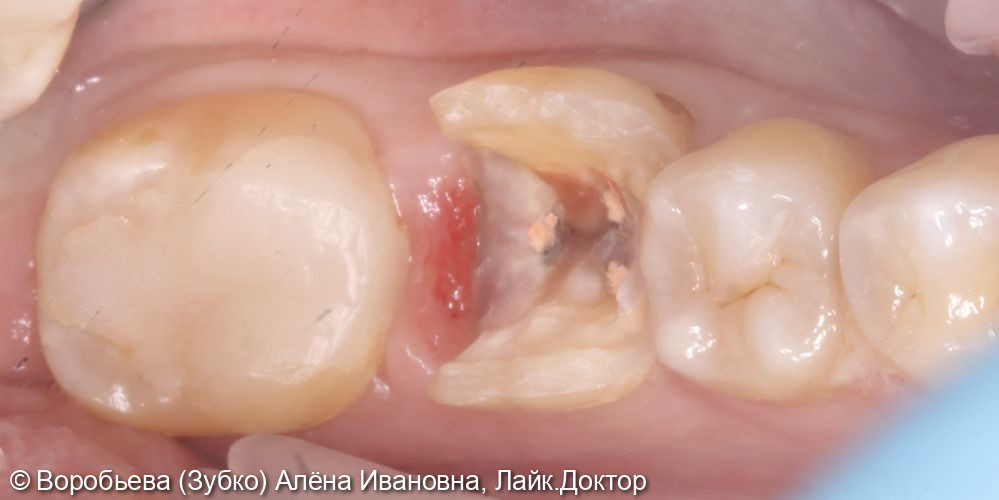 Лечение периодонтита 36 зуба и лечение кариеса 35 зуба - фото №3