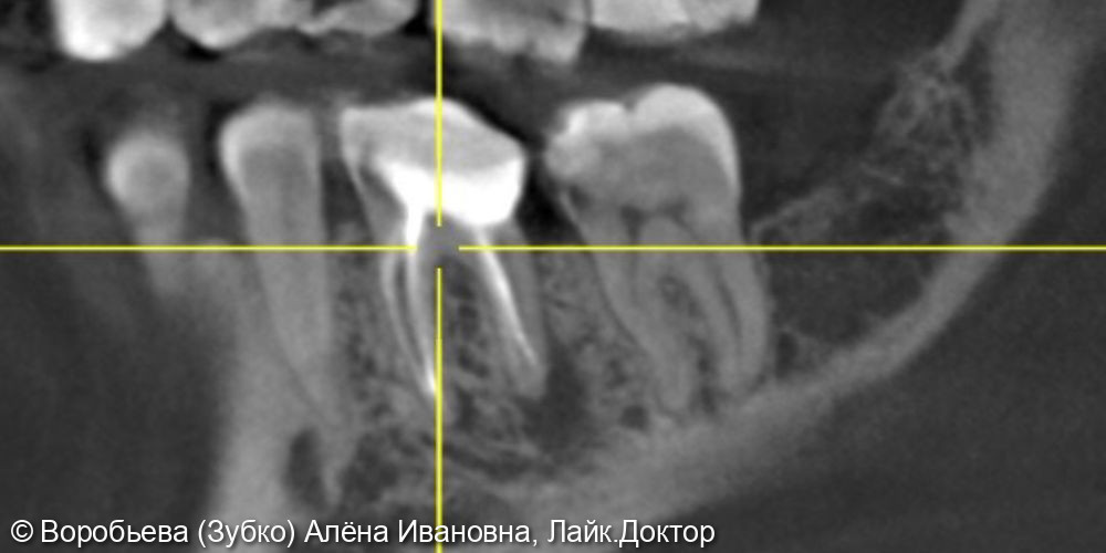 Лечение периодонтита 36 зуба и лечение кариеса 35 зуба - фото №5