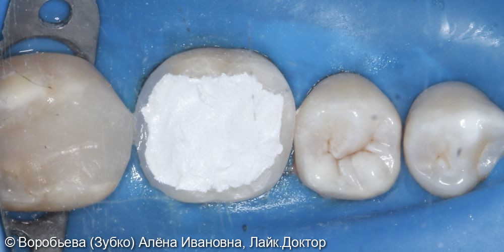 Лечение периодонтита 36 зуба и лечение кариеса 35 зуба - фото №10
