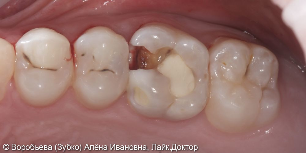 Лечение кариеса 17 зуба и лечение пульпита 16 зуба - фото №1