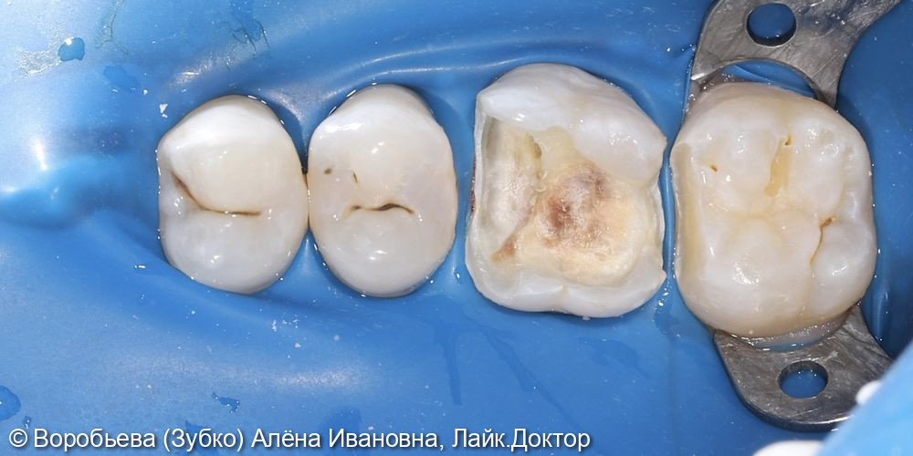 Лечение кариеса 17 зуба и лечение пульпита 16 зуба - фото №2