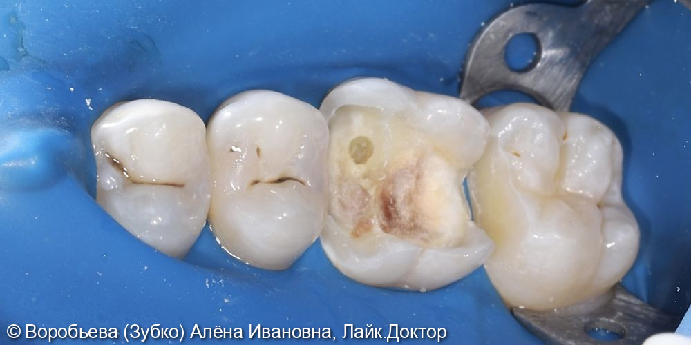 Лечение кариеса 17 зуба и лечение пульпита 16 зуба - фото №3