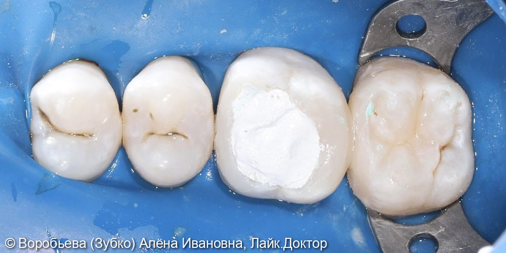 Лечение кариеса 17 зуба и лечение пульпита 16 зуба - фото №4