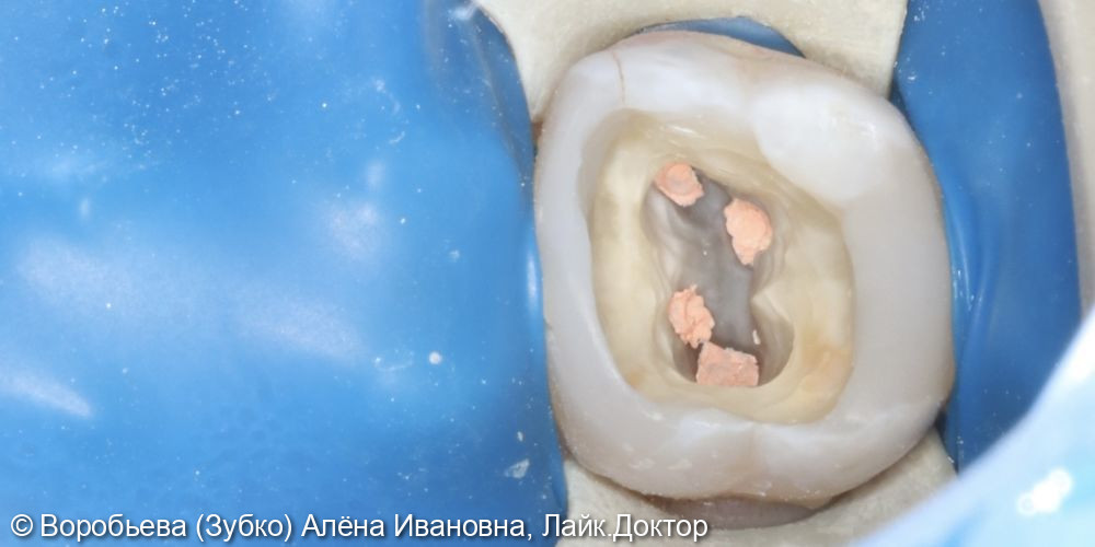 Лечение кариеса 17 зуба и лечение пульпита 16 зуба - фото №5