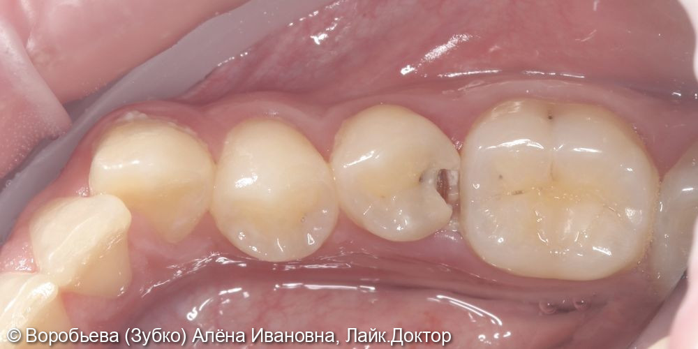 Лечение кариеса 45 зуба - фото №1